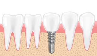 Diagram of an integrated dental implant in San Antonio