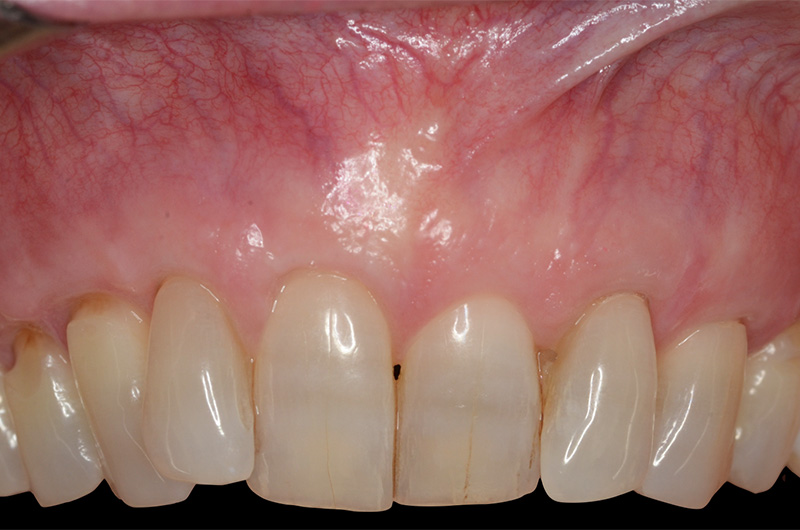 Healthy smile with root structure covered at gum grafting