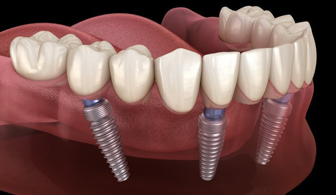 diagram of All-on-4 implants in the jaw