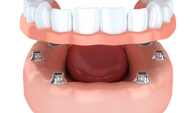 diagram of All-on-4 denture being attached to dental implants