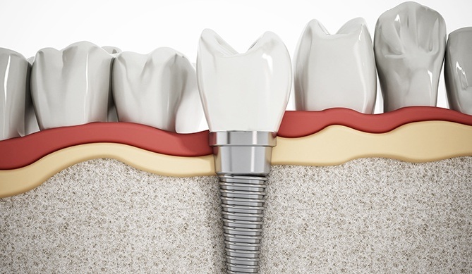 Animated smile after ridge preservation and dental implant placement