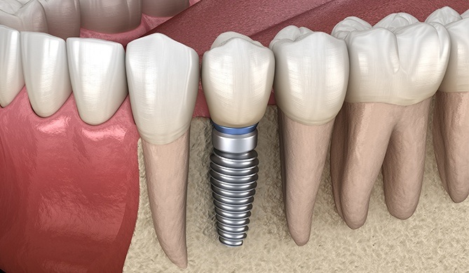 Animated rendering of bone graft and dental implant placement