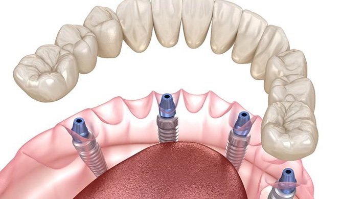Digital illustration of All-On-4/ Pro Arch dental implants being placed