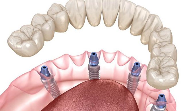 Digital illustration of All-On-4/ Pro Arch dental implants being placed