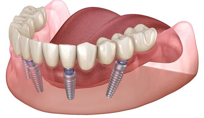 digital illustration of all-on-4 dental implants in San Antonio
