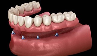 Digital illustration of all-on-4 dentures in San Antonio before placement