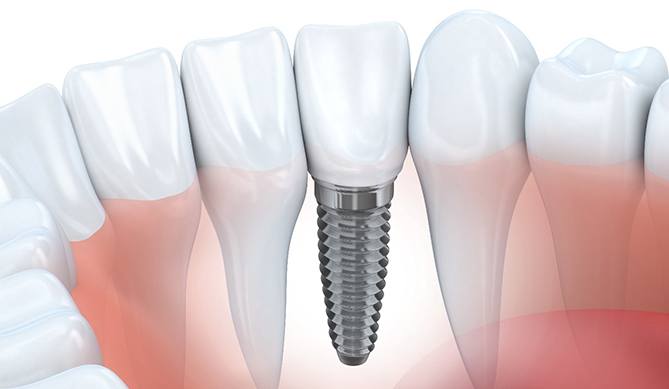 A diagram of a dental implant.