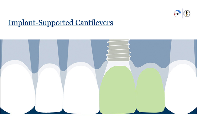 Animated rendering showing the right and left sinus