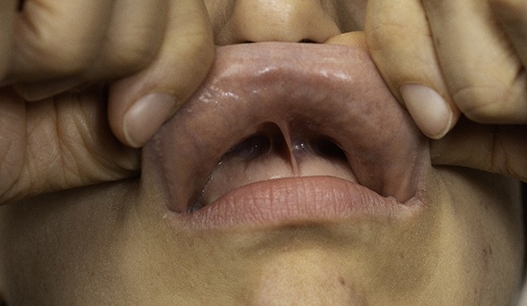An up-close image of a person exposing the underside of their upper lip and their lip tie