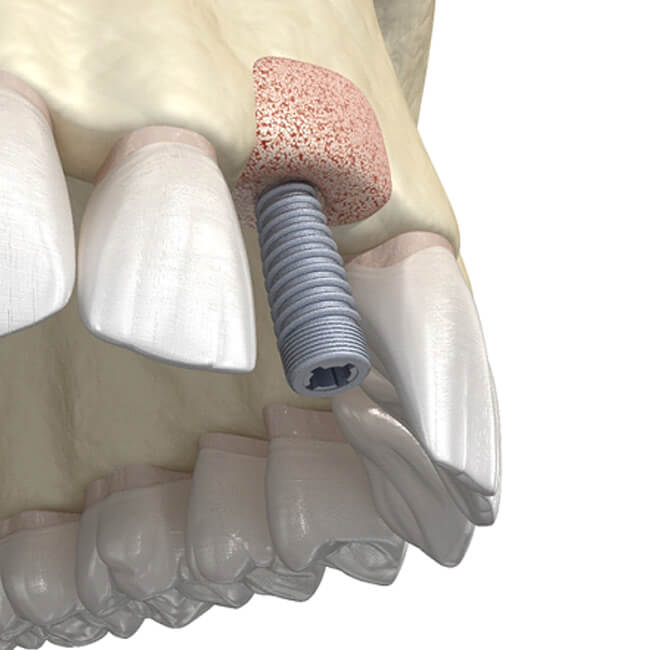 Dental implant in jaw after bone graft in San Antonio, TX