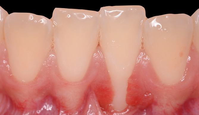 Smile with exposed tooth root before gum grafting treatment