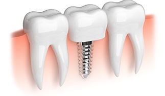 Model of lower arch with parts of dental implants in San Antonio, TX