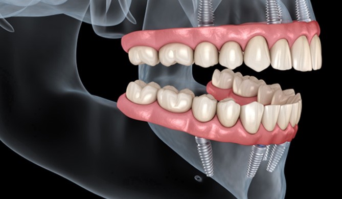 Illustration of implant dentures for upper and lower arches