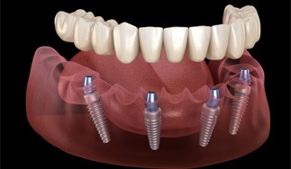 Illustration of implant dentures for lower dental arch