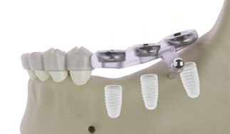 a surgical implant guide placed atop a model of a jawbone