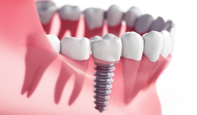 Animated dental implant supported dental crown