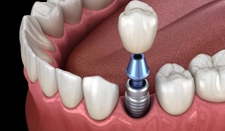 Animated dental implant supported dental crown