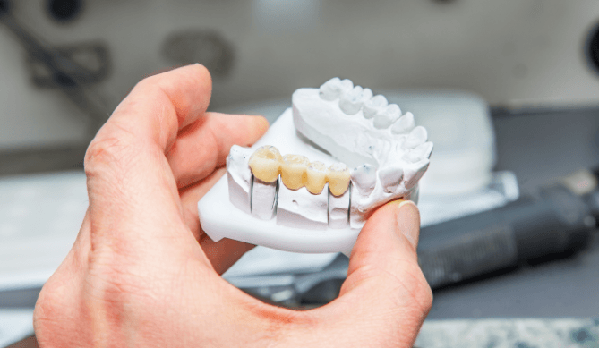 Model smile with dental implant supported fixed bridge