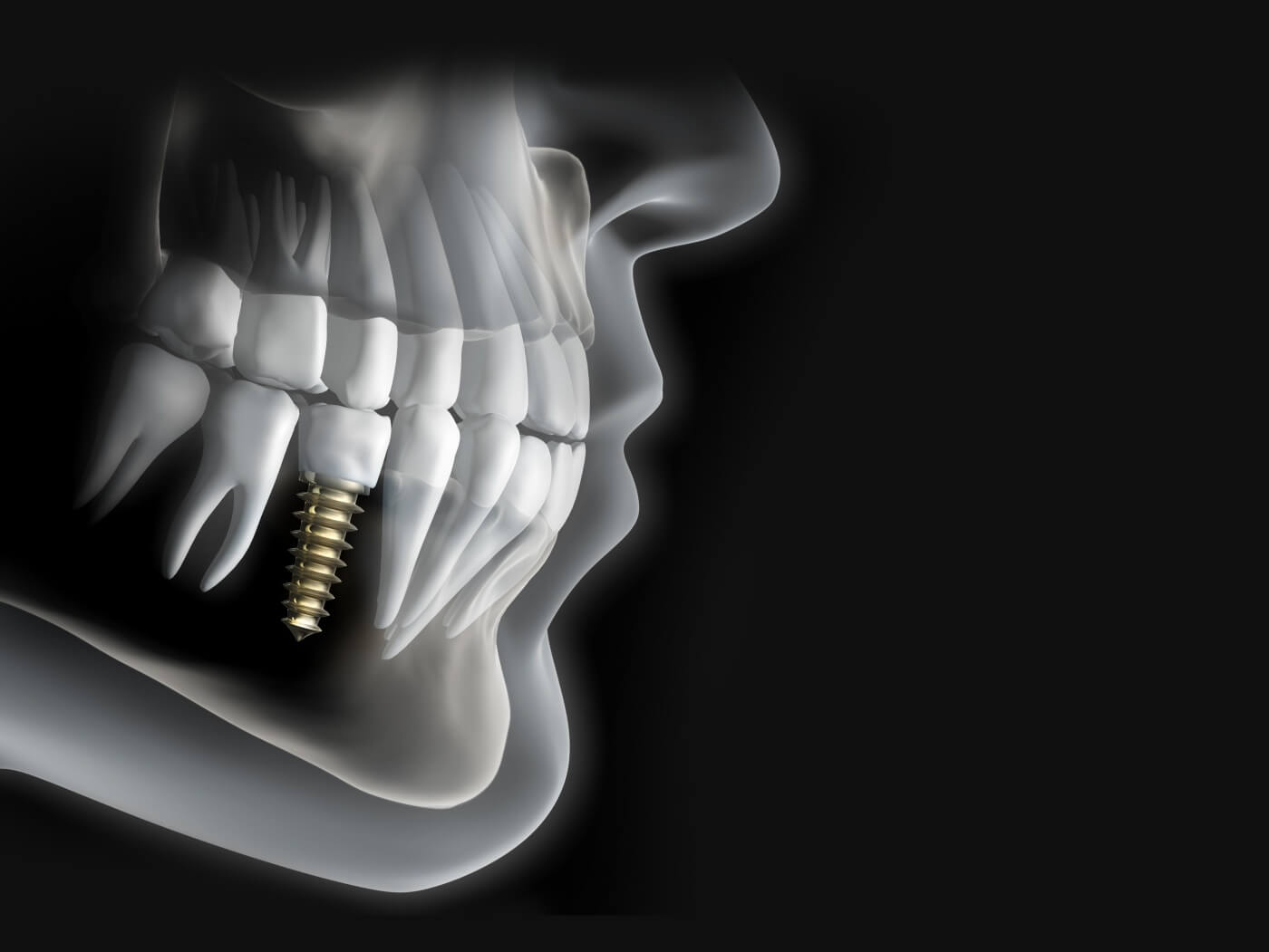 Animated smile with a dental implant supported dental crown