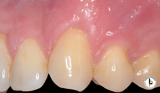 Tooth root covered after gum grafting