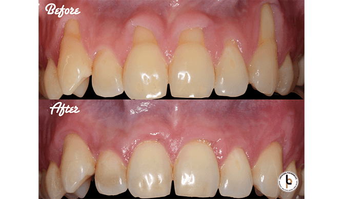 Tooth root covered after gum grafting