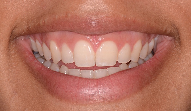 Gorgous smile after aesthetic gum recontouring treatment