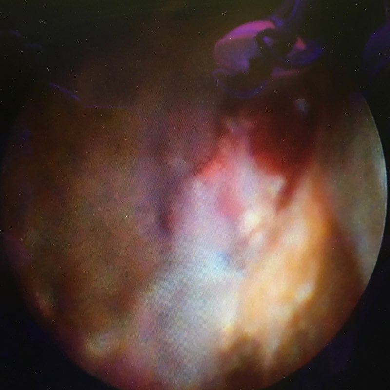 Perioscopy image of calculus on the tooth's root