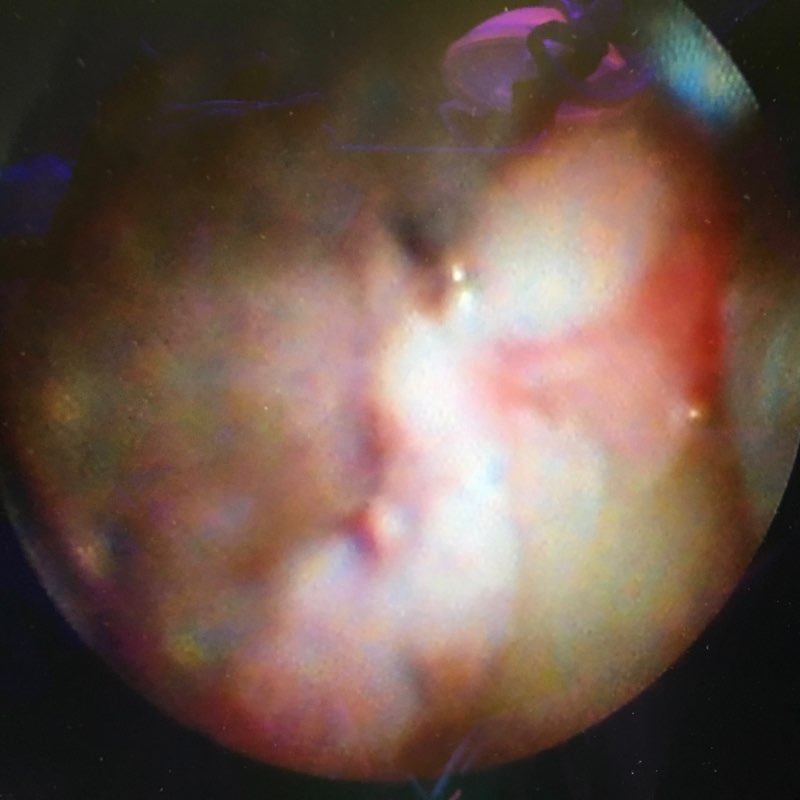 Perioscopy image of tooth root after calculus removal