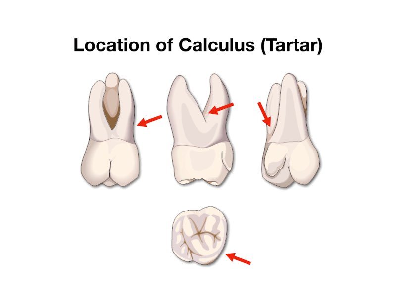 Animated teeth with location of calculus depicted