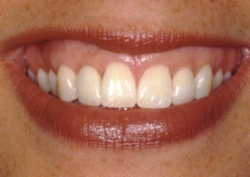Full smile after soft tissue ridge augmentation