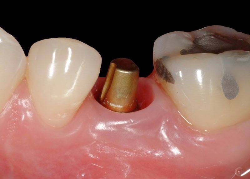 Image of smile with dental implant abutment piece in place