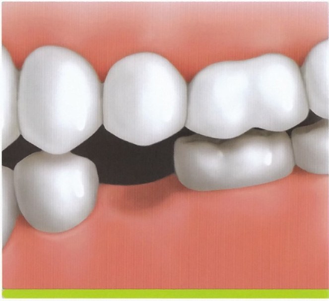 Animated rending of smile with missing tooth