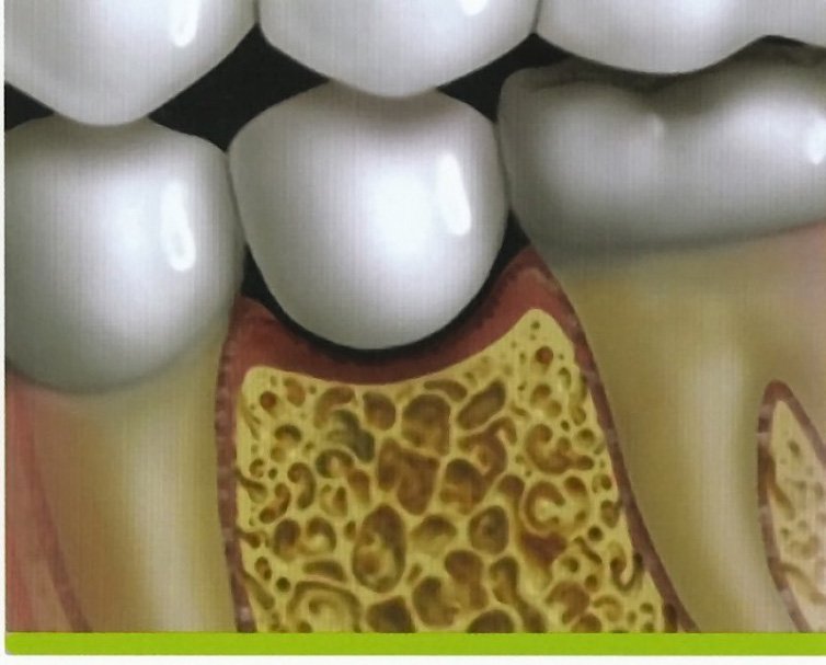 Animated smile with traditional fixed bridge