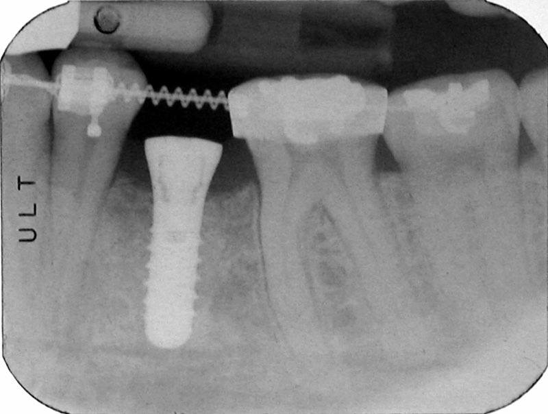 X-ray of smile with dental implant post in place
