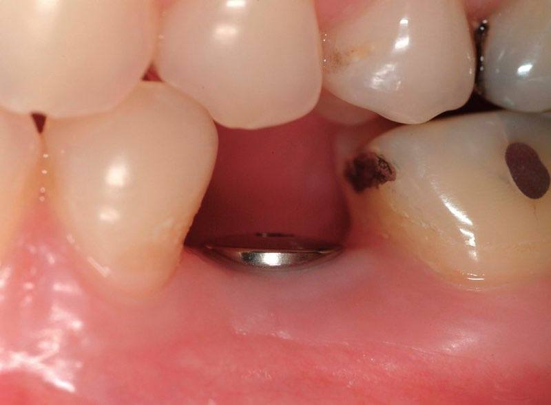 Smile with dental implant post visible before replacement tooth is attached