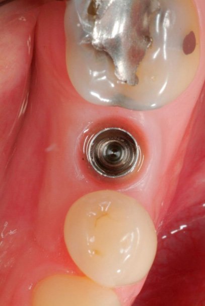 Top view of gum tissue with dental implant post visible