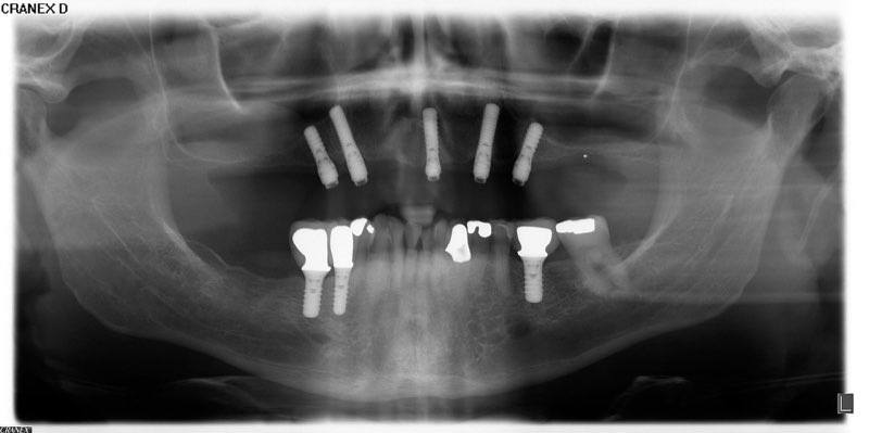 X-ray of smile with dental implant posts