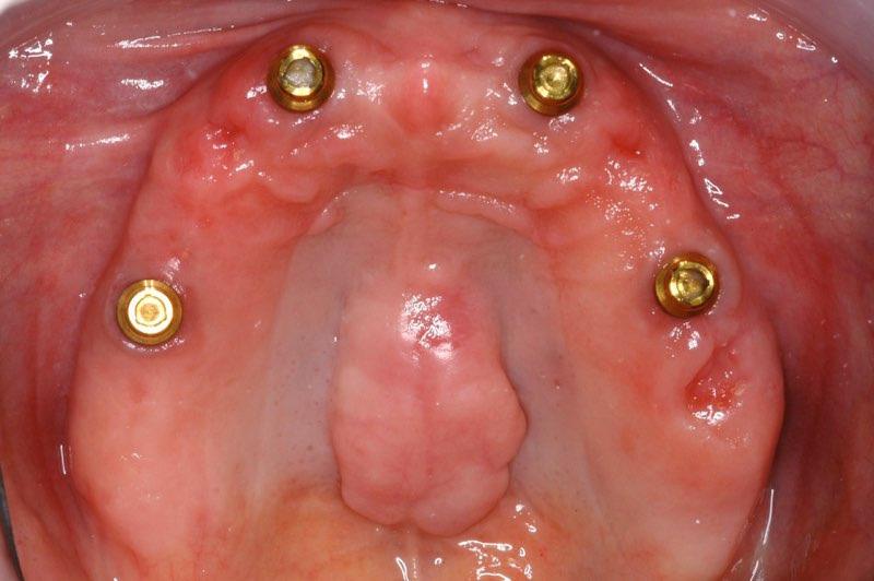 Smile with newly placed dental implant posts