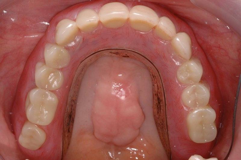 Denture placed over dental implants