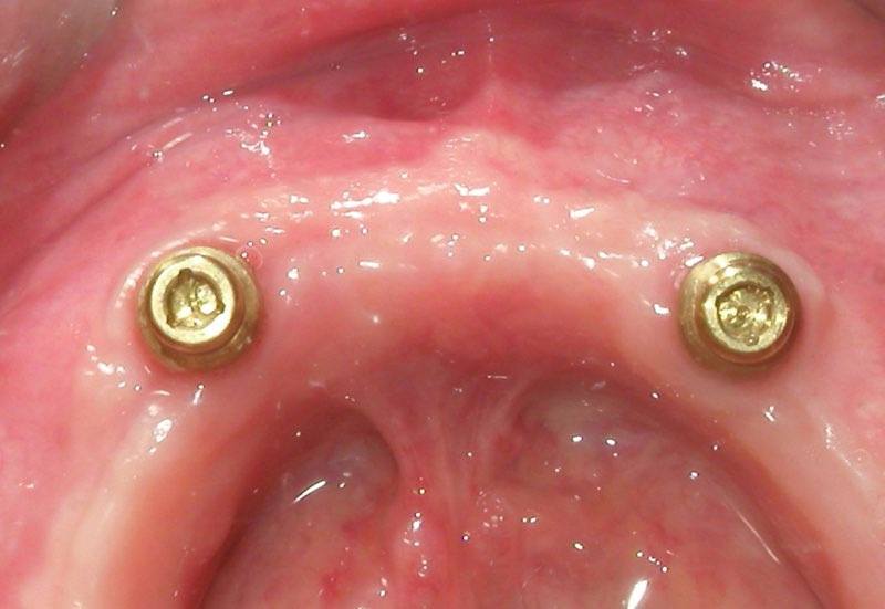 Smile with two dental implant posts visible