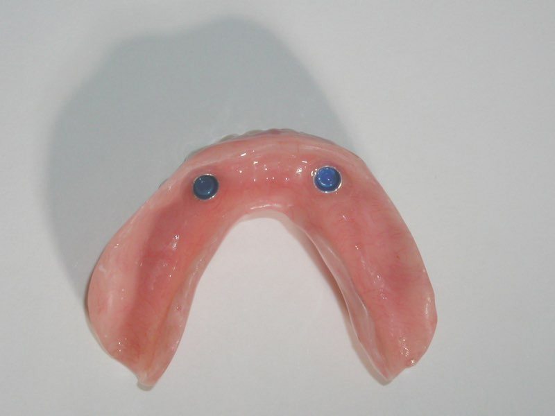 Denture with dental implant post snaps
