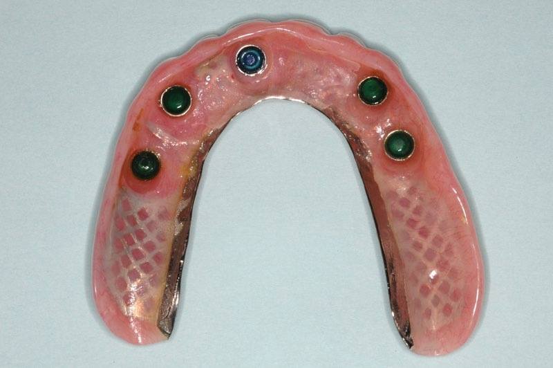 Denture with spaces that correspond to dental implant posts