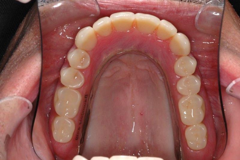 Smile after denture is placed over dental implants