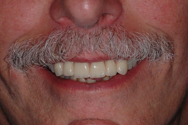 Patient smiling after denture placement