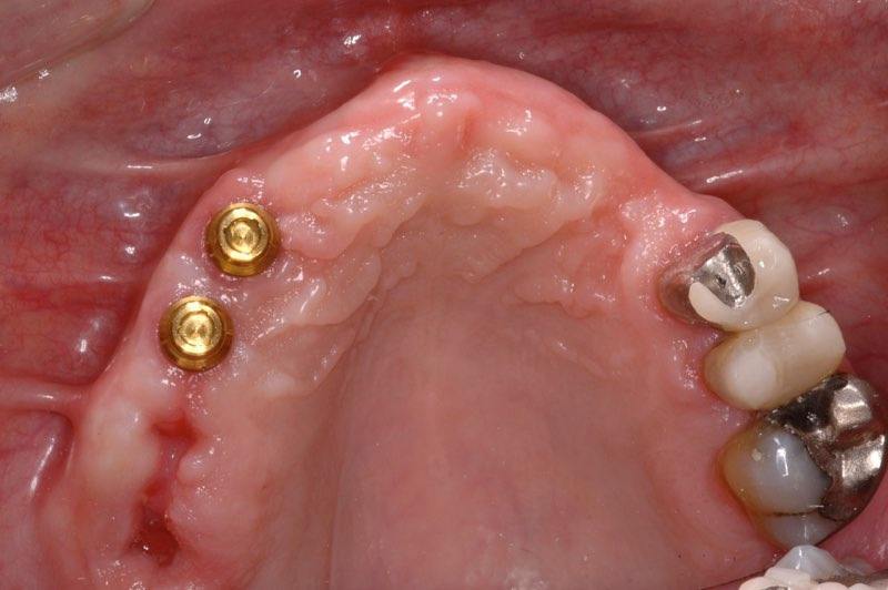 Smile extensive tooth loss two dental implant visible in the gum line