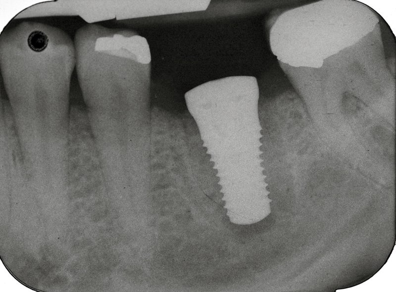 X-ray of smile with dental implant post