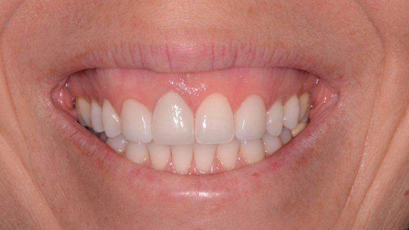 Smiling patient after dental implant tooth replacement