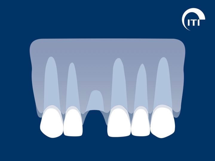 Animated smile with missing tooth