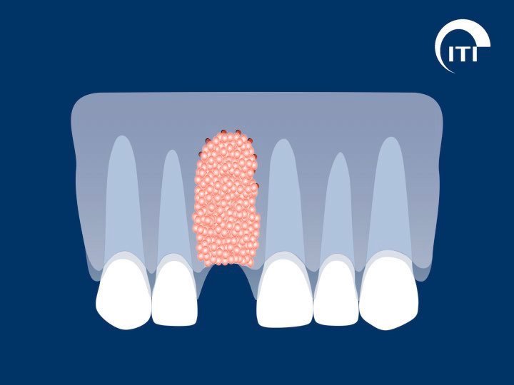 Animated smile with bone graft