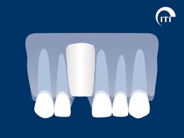 Animated smile with bone graft and collagen membrane